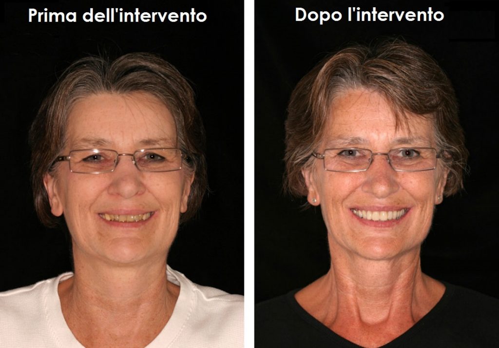 Carico immediato prima e dopo